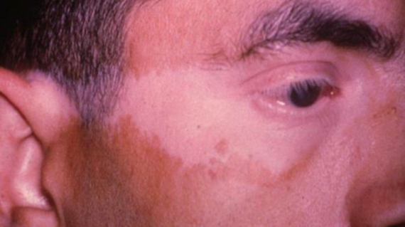 متلازمة هارادا