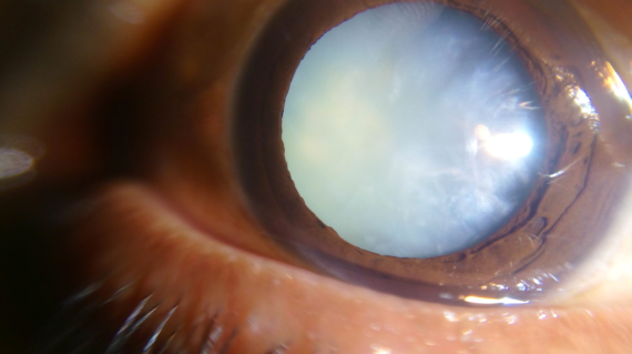 أسباب المياه البيضاء