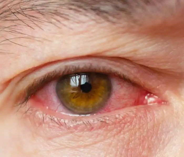 أضرار حقن العين

