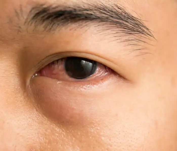 تكلفة حقن العين لعلاج الارتشاح
