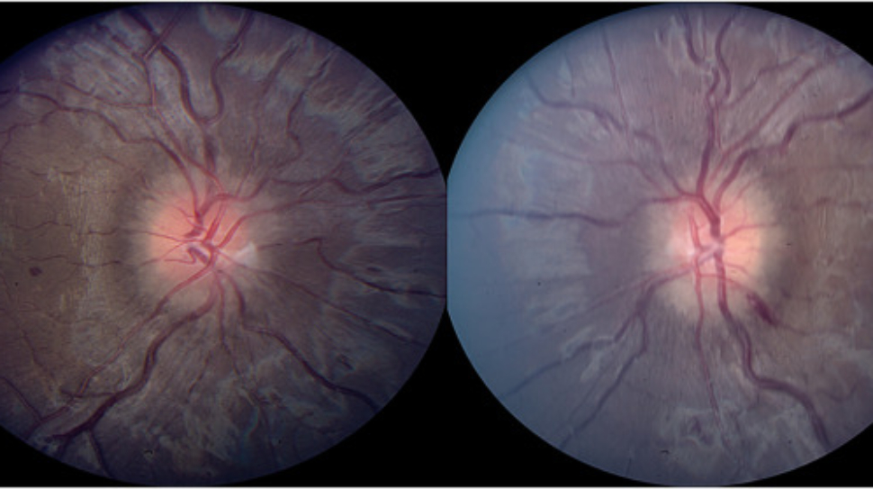وذمة حليمة العصب البصري