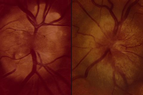 وذمة حليمة العصب البصري (Papilledema) هو نوع من التورم في القرص البصري والعصب البصري بسبب ارتفاع الضغط داخل الجمجمة (ICP).