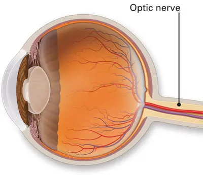 التهاب العصب البصري هو تورم في العصب البصري للعين. يؤثر هذا النوع من الالتهاب على الرؤية ويسبب الألم. يصيب عادةً عين واحدة، ولكن أحيانًا يؤثرعلى كلتا العينين في نفس الوقت. وأيضًا يؤثر على البالغين والأطفال على حد سواء.