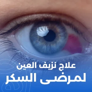 علاج نزيف العين لمرضى السكر
