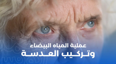 عملية المياه البيضاء وتركيب عدسة