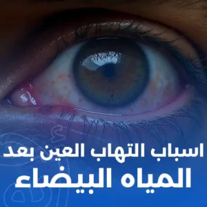 أسباب التهاب العين بعد عملية المياه البيضاء